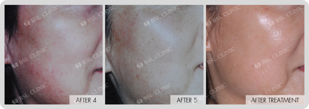 Skin Brightening and Whitening Treatment Bangkok Aesthetic Clinic