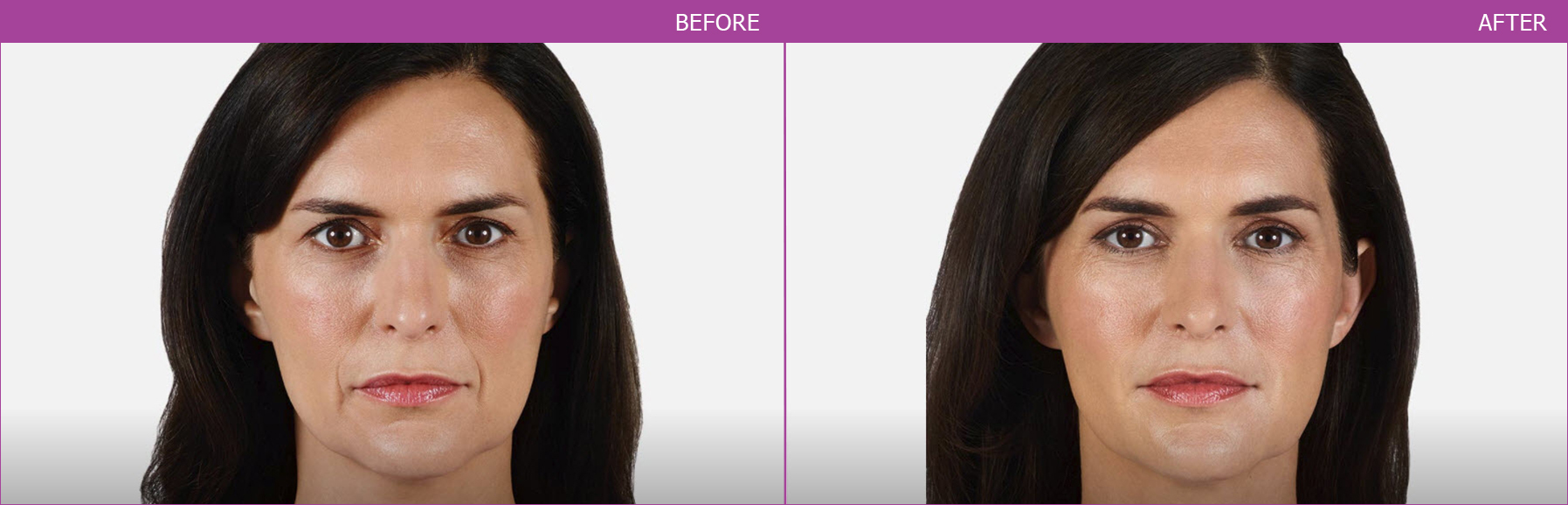 HA Filler (USA) - Bangkok Aesthetic Clinic