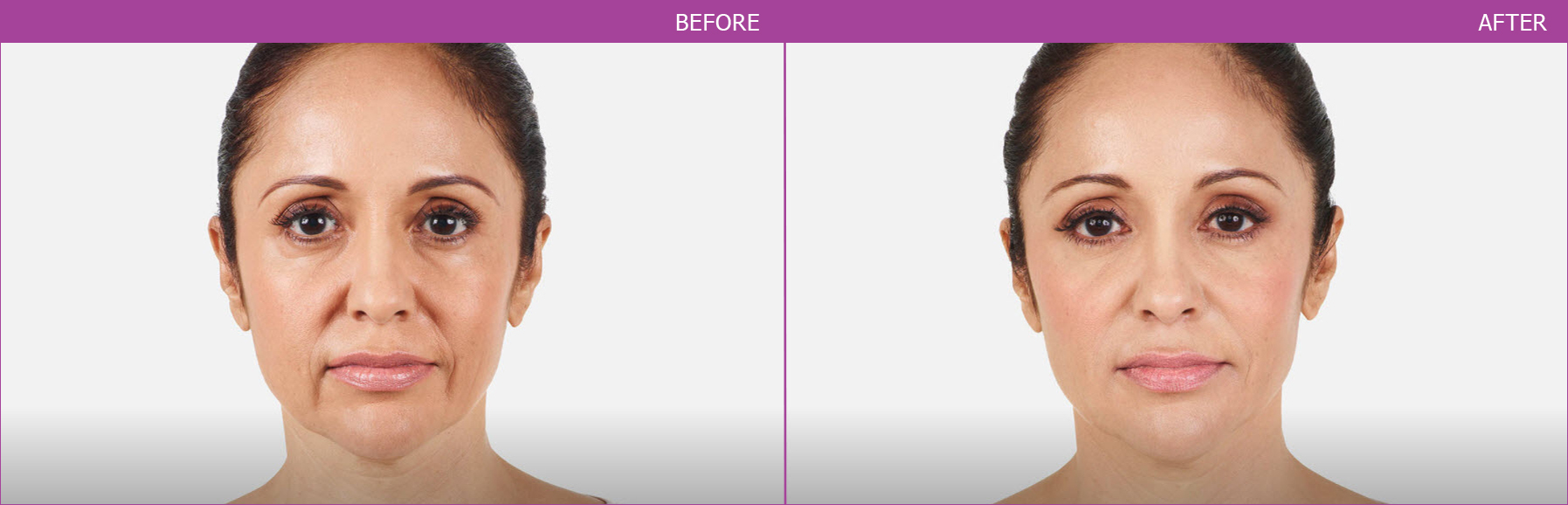 HA Filler (USA) - Bangkok Aesthetic Clinic