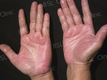 Dermatitis seborreica - Dermaclinic