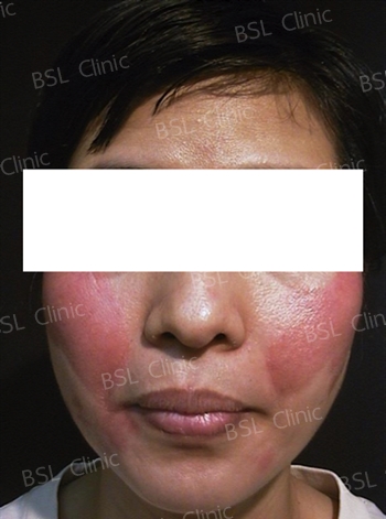 Dermatitis seborreica - Dermaclinic