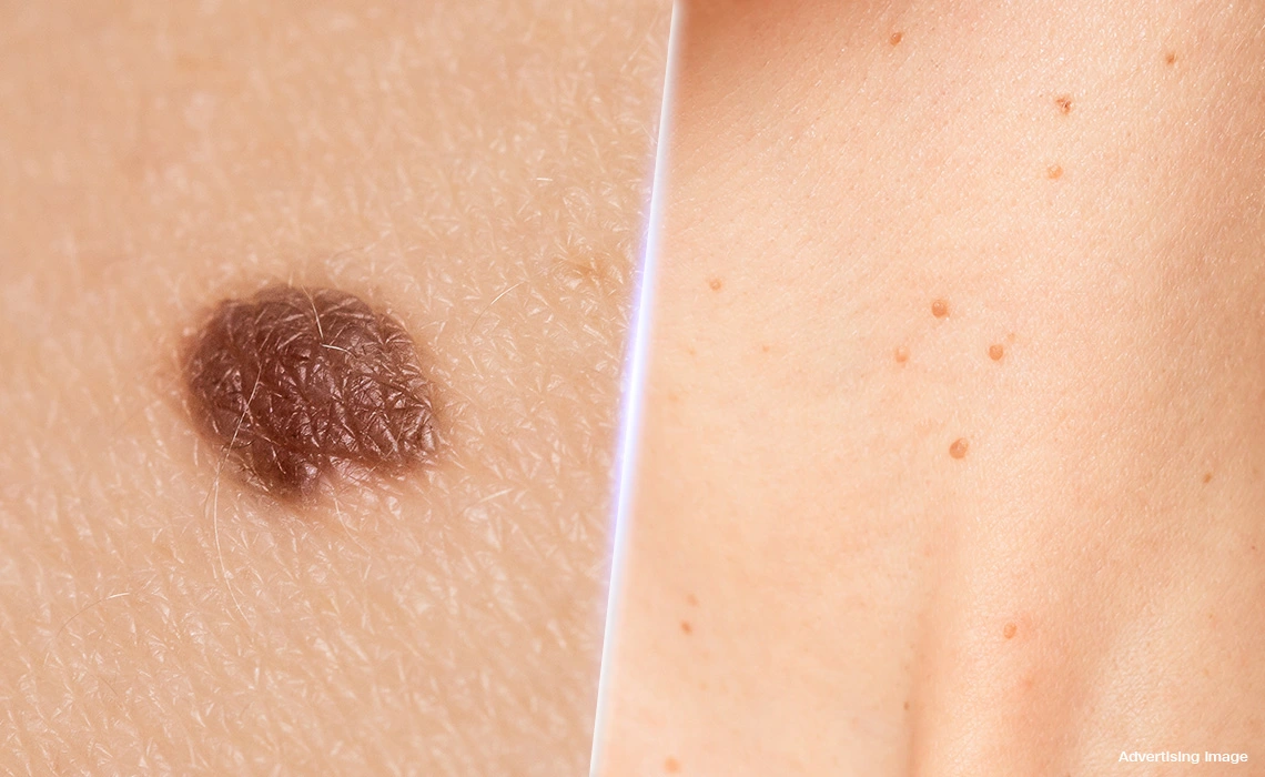 Moles and Skin Tags