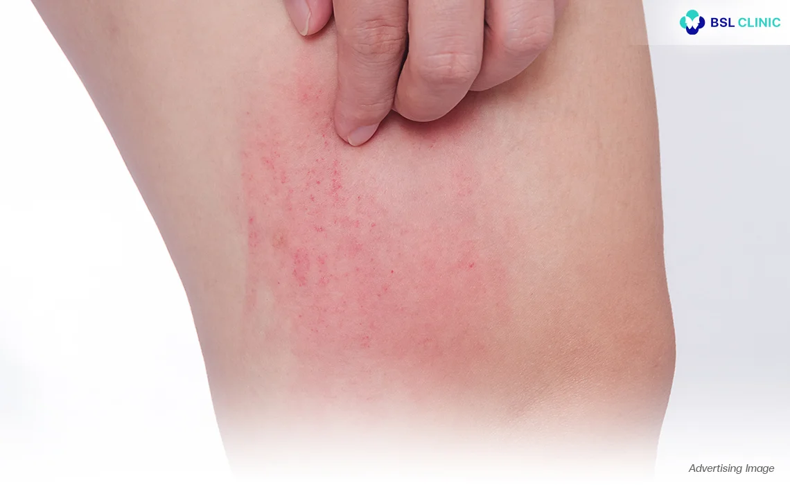 Skin-Allergies