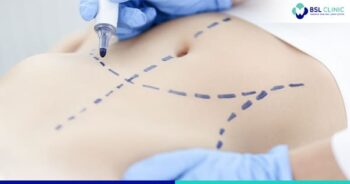 beauty article - Liposuction Treatment