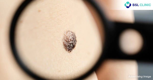 article Treatment Moles