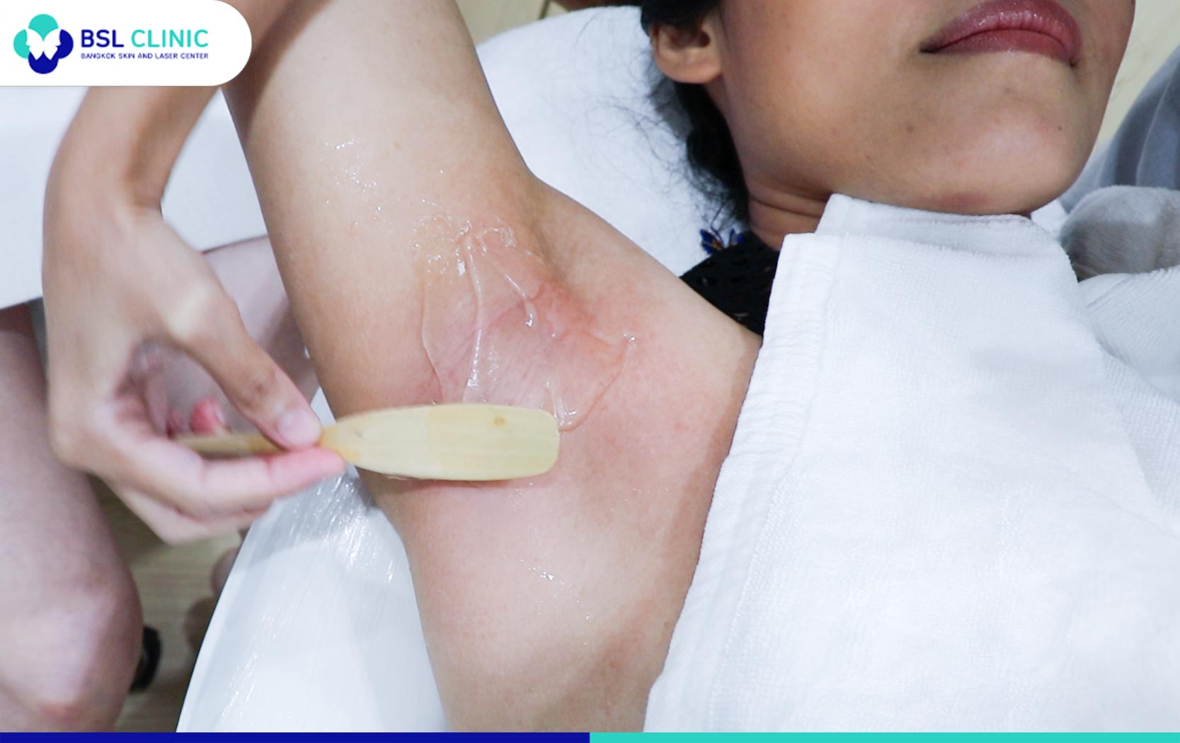Remove underarm hair and throw tweezers and razors away - Bangkok Aesthetic  Clinic