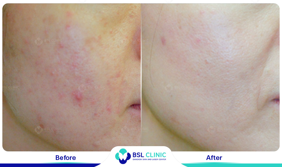 Before-and-After-Treatments-of-Seborrheic-Dermatitis-02