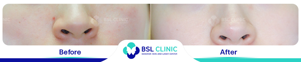 Before-and-After-Treatments-of-Seborrheic-Dermatitis-03