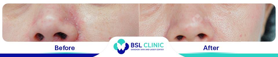 Before-and-After-Treatments-of-Seborrheic-Dermatitis