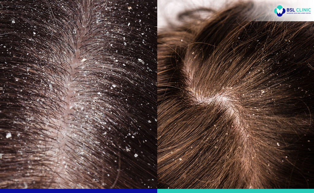 Dandruff Itchy Scalp - Bangkok Aesthetic Clinic