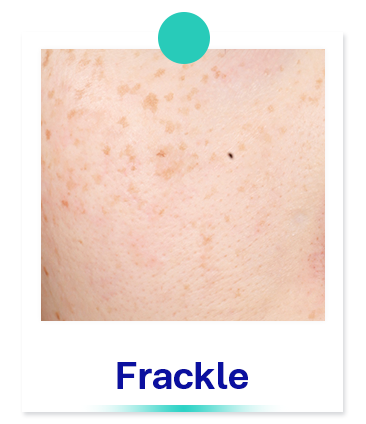 Freckle-Frackles-dark-spot