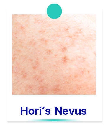 Hori’s-nevus-Frackles-dark-spot