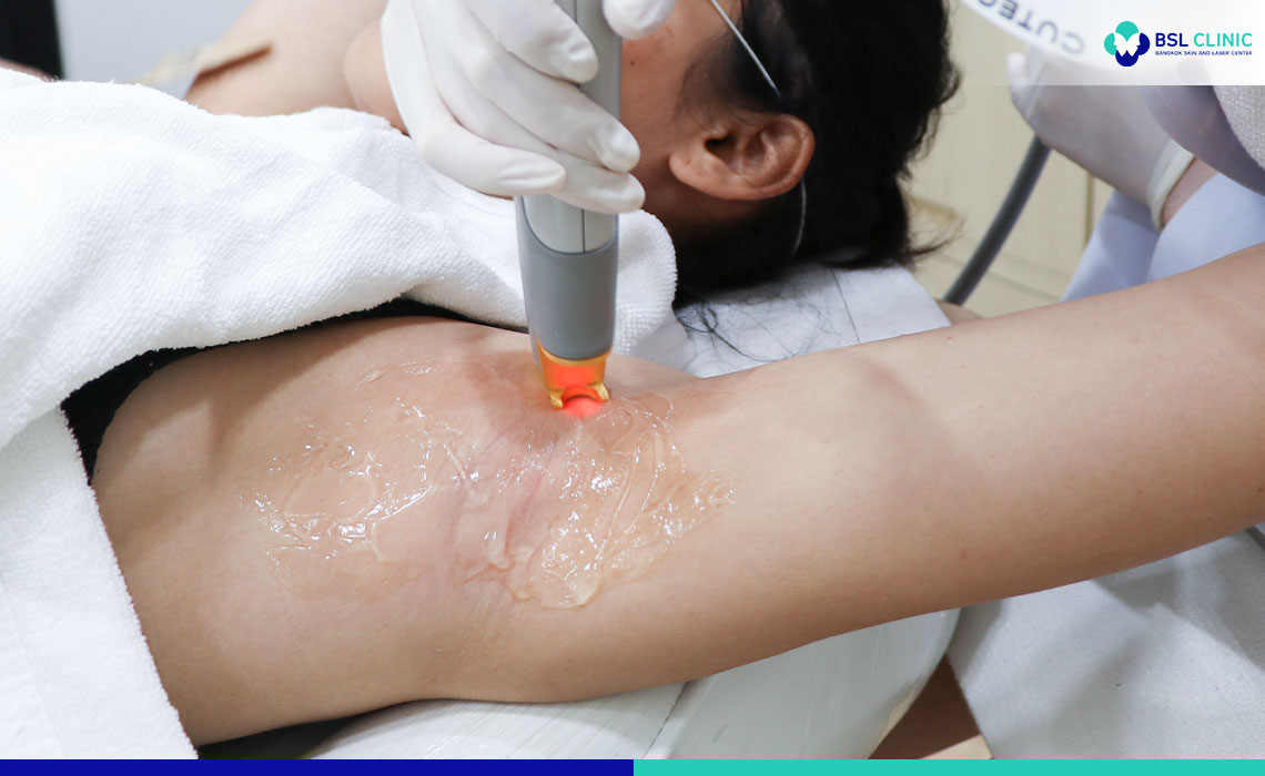 REMOVE-UNDERARM-HAIR-WITH-LASER