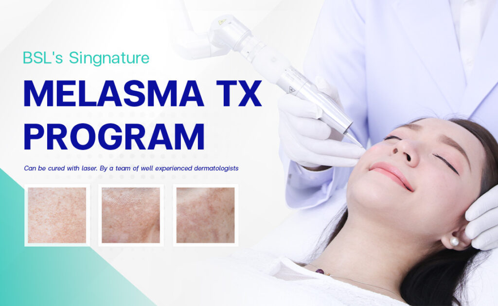 Melasma (Mask Of Pregnancy) - Bangkok Aesthetic Clinic