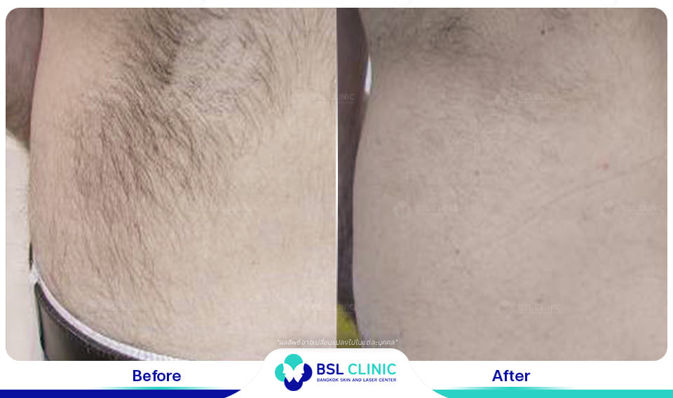 results hair removal