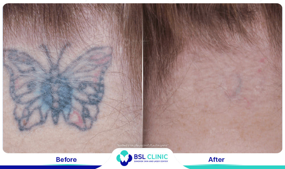results - tattoo removal