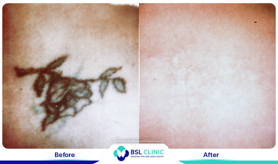 results - tattoo removal