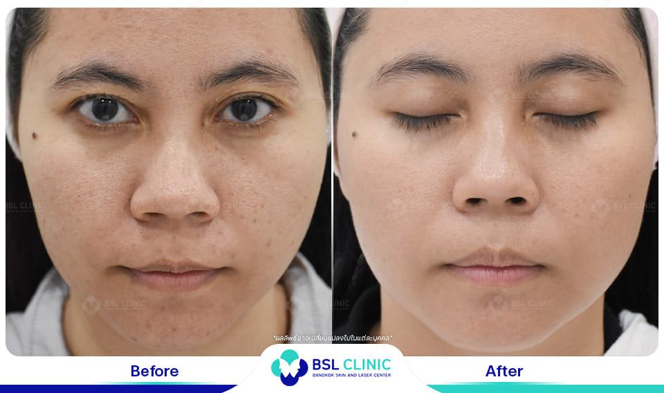 Before-and-After-Treatments-of-Seborrheic-Dermatitis