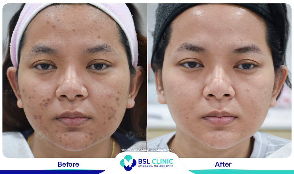 Skin-Brightening-and-Whitening-Treatment