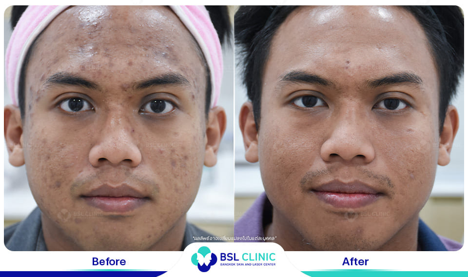 Skin-Brightening-and-Whitening-Treatment