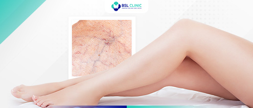 Spider and Varicose Veins - Bangkok Aesthetic Clinic