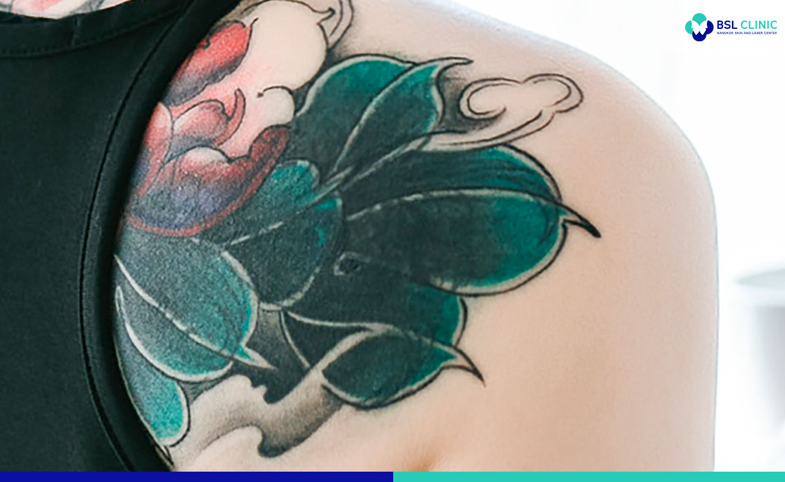 The Laser Tattoo Removal Healing Process | Removery