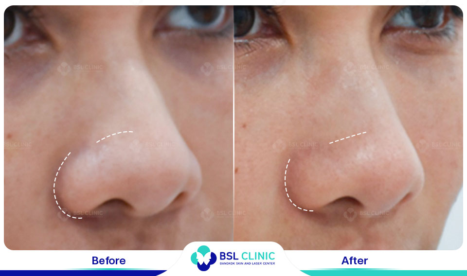result-Nose-Reshaping