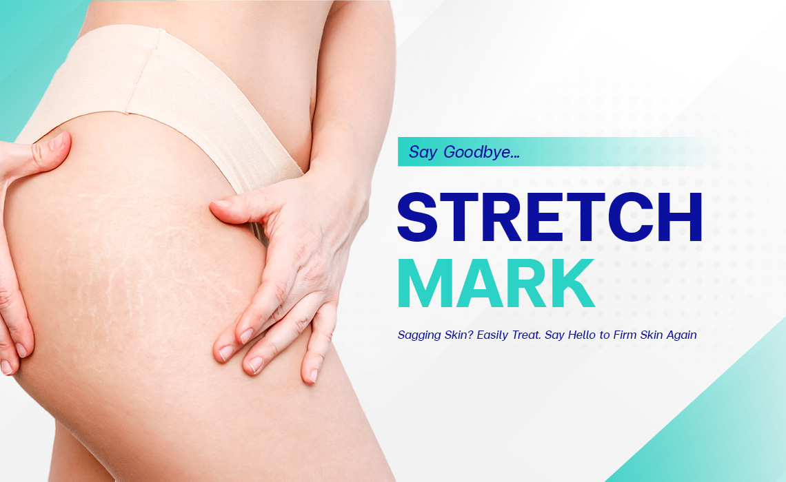 Stretch-Marks-and-Saggy-Skin