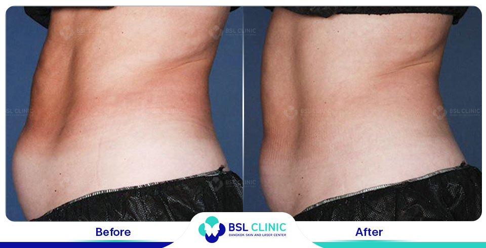 _before-after-fat-removal