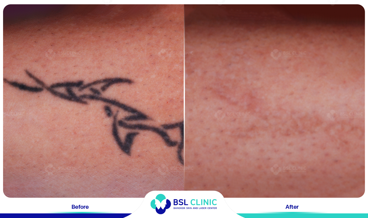 Tattoo Removal in Chandigarh | Aura Skin Institute