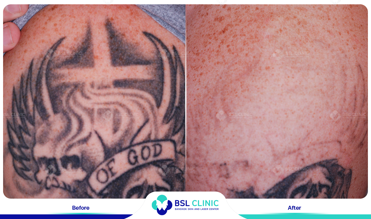 Laser Tattoo Removal. Read This Before Going Under the Laser!