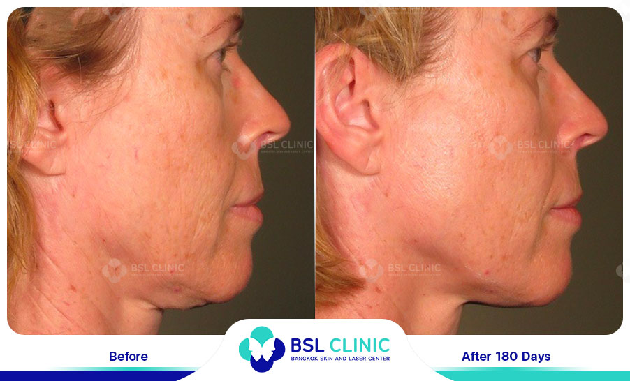 result-Facelift-Ulthera