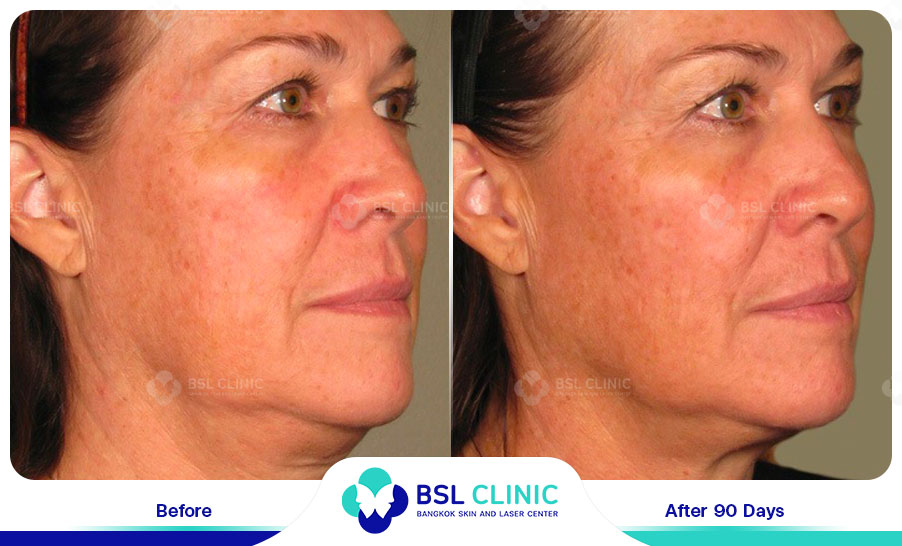 result-Facelift-Ulthera