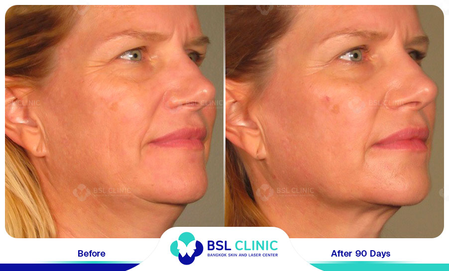 result-Facelift-Ulthera