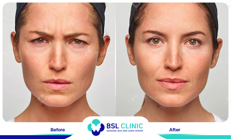 result-aniti-wrinkles--aging