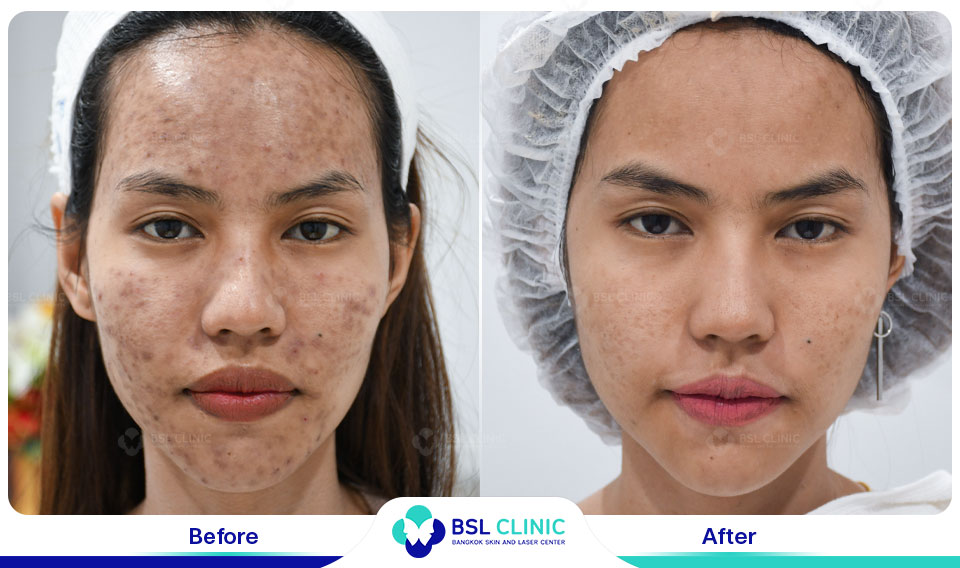 results-Pigmented-Laser