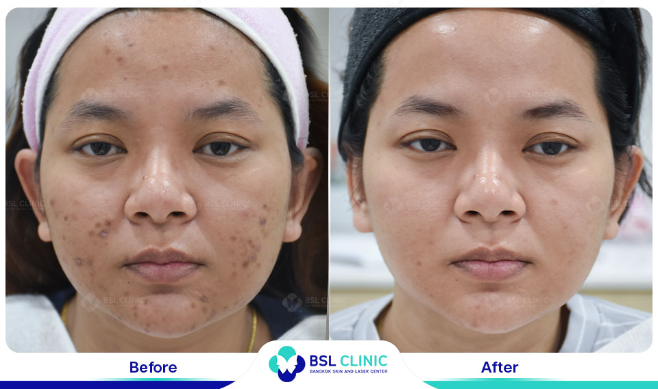results-Pigmented-Laser
