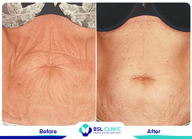 results-The-Skin-Tightening-Forma-01