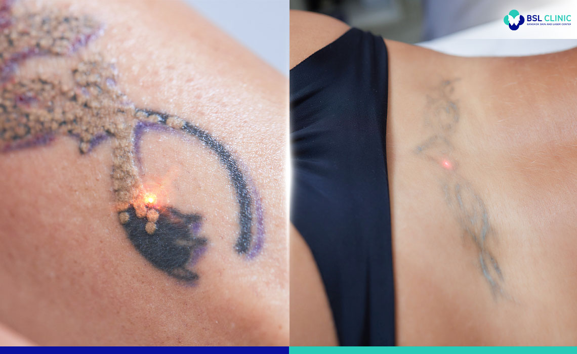Laser Tattoo Removal Troy, MI - Pain Free Tattoo Removal