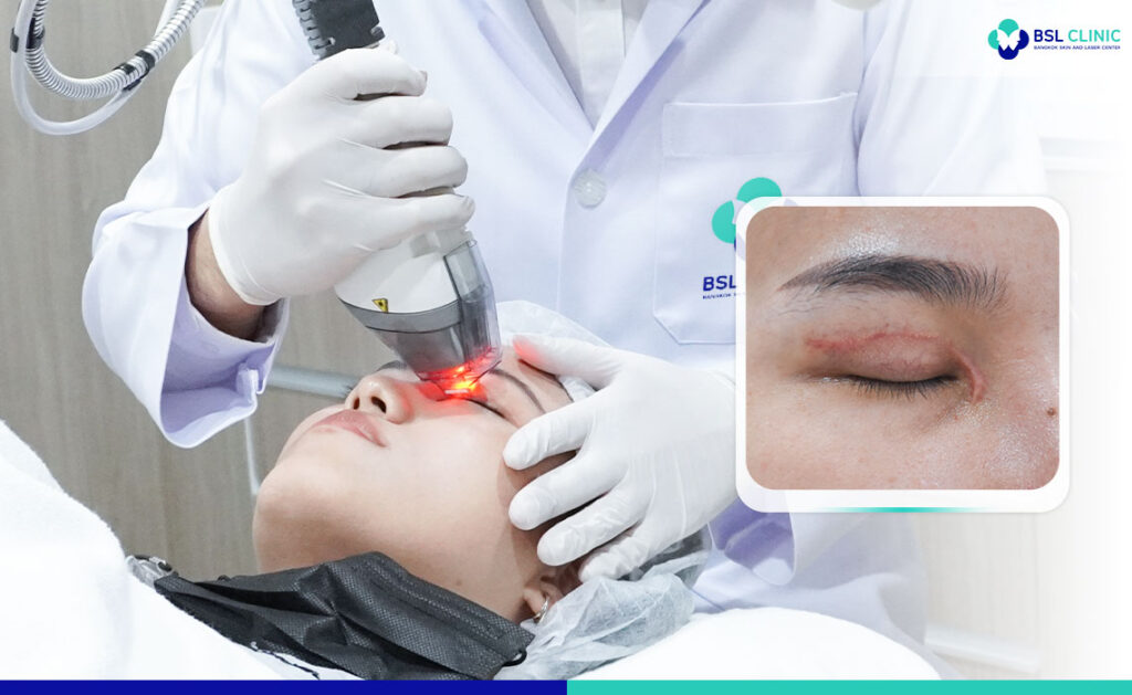 Scar Removal Laser Bangkok Aesthetic Clinic