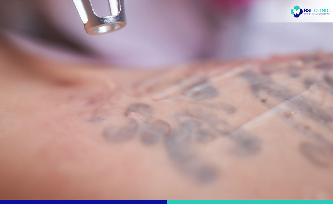 What-is-it--Laser-tattoo-removal