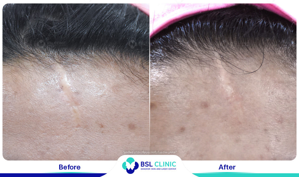 result-scar