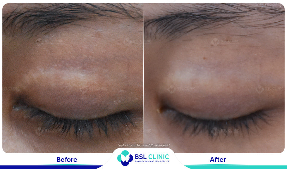 result-scar