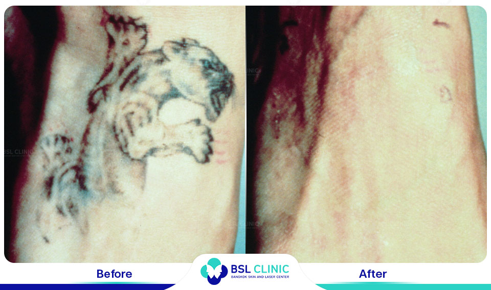 before-after-tattoo-removal-revlite-laser