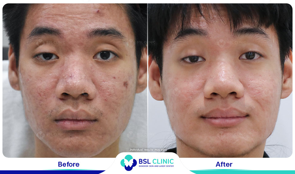 result-acne-scar