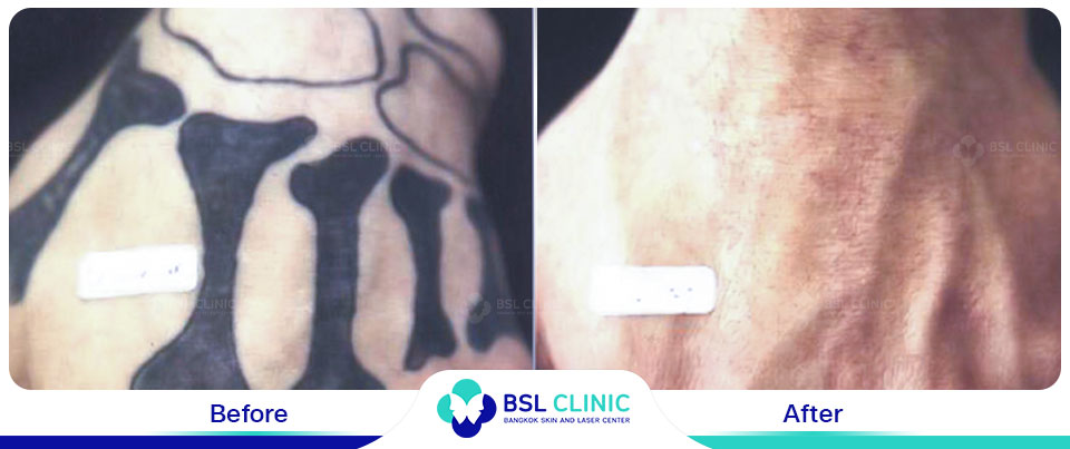 The-results-tattoo-removal-Asclepion-Q-Switched-Ruby-Laser