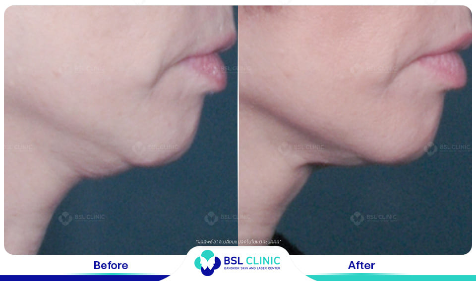 Face Lifting Treatments