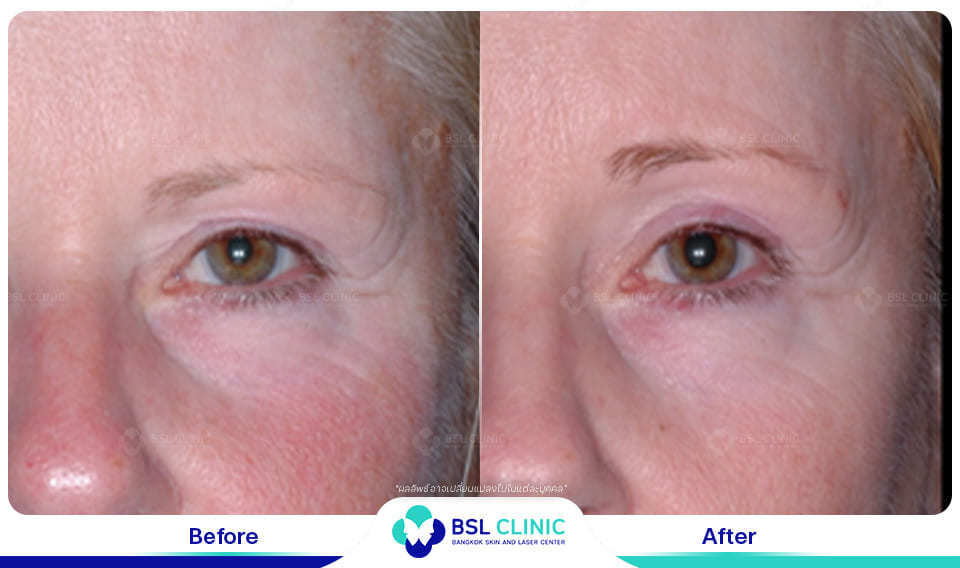Face Lifting Treatments