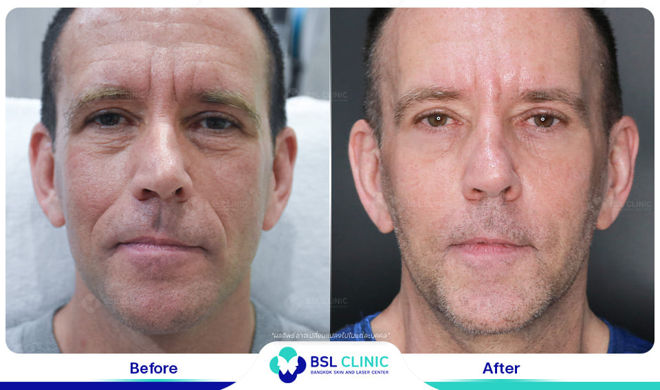 Face Lifting Treatments