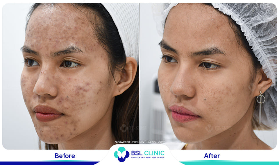 Skin Brightening and Whitening Treatments